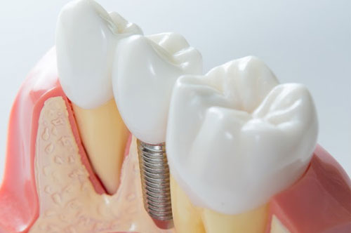 Image Text: dental_implants_3