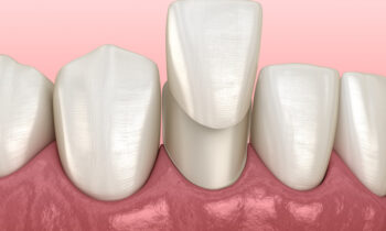 Image Text: dental veneers, dental crowns, cavities, prevent cavities, dentist in Arlington, TX