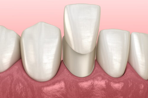 Image Text: dental veneers, dental crowns, cavities, prevent cavities, dentist in Arlington, TX