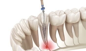 Image Text: root canal, root canal aftercare, tooth sensitivity, dental hygiene, root canal recovery, Fielder Park Dental, Arlington dentist, Dr. Chip Mercer, dental care tips, dentist in arlington, root canal arlington