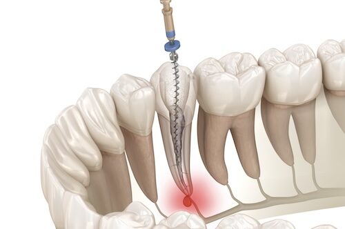 Image Text: root canal, root canal aftercare, tooth sensitivity, dental hygiene, root canal recovery, Fielder Park Dental, Arlington dentist, Dr. Chip Mercer, dental care tips, dentist in arlington, root canal arlington