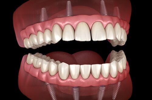 Image Text: all-on-4 implant dentures