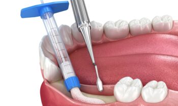 Bone grafting, augmentation. Medically accurate 3D illustration. Image Text: image of a dental bone graft