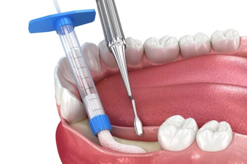 Image Text: image of a dental bone graft