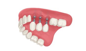 50730990617_a12c83c751_c Image Text: dental implants for missing teeth, dental implants vs dentures for missing teeth
