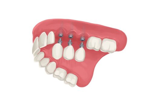 Image Text: dental implants for missing teeth, dental implants vs dentures for missing teeth