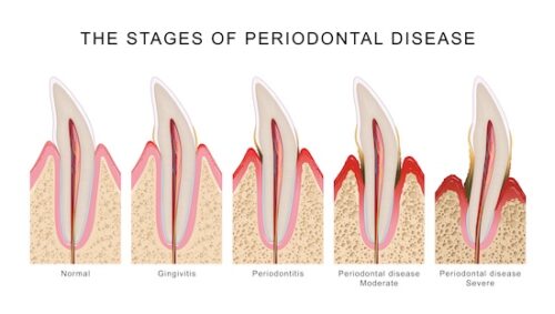 Image Text: stages of gum disease