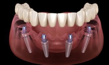 Image Text: all on 4 dental implant dentures