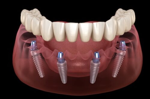 Mandibular prosthesis All on 4 system supported by implants. Medically accurate 3D illustration of human teeth and dentures concept Image Text: all on 4 dental implant dentures