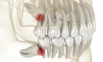 Image Text: wisdom teeth removal, wisdom teeth impaction