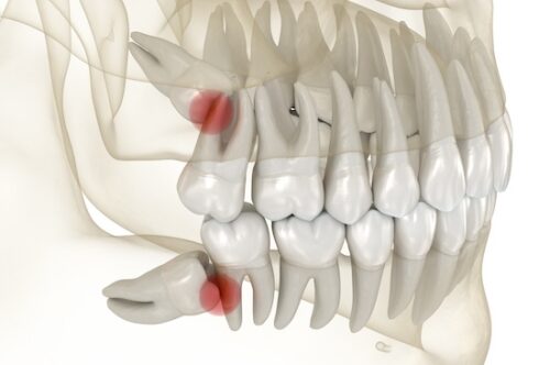 Mesial impaction of Wisdom teeth. Medically accurate tooth 3D illustration Image Text: wisdom teeth removal, wisdom teeth impaction