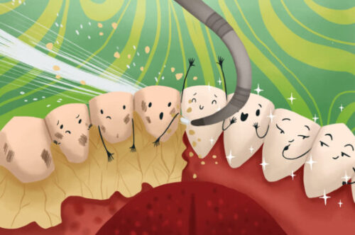 Image Text: deep cleaning aftercare, image of a dental cleaning or deep cleaning removing tartar